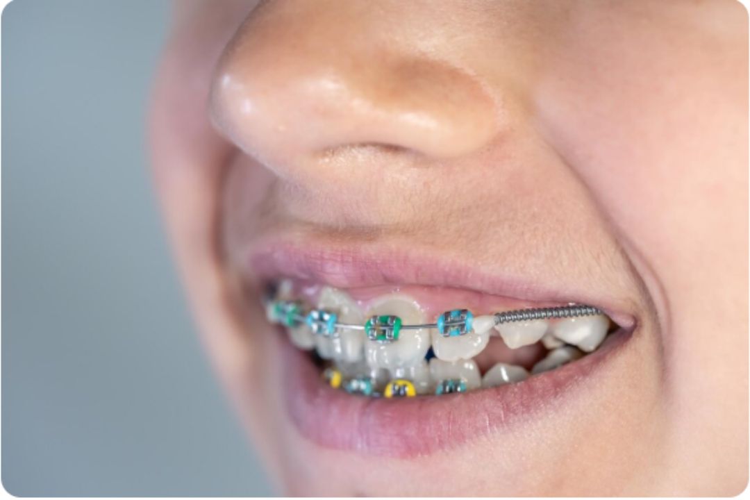types of dental braces available in mumbai